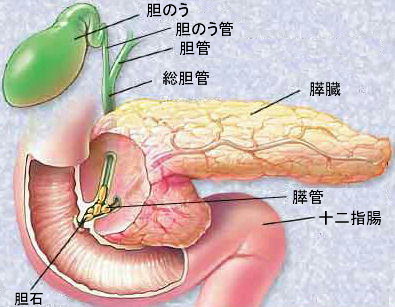gallstones
